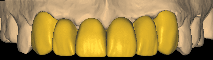 6-Unit Anterior Canine to Canine Bridge CAD Design