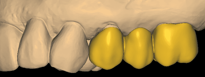 3-Unit Posterior Bridge CAD Design