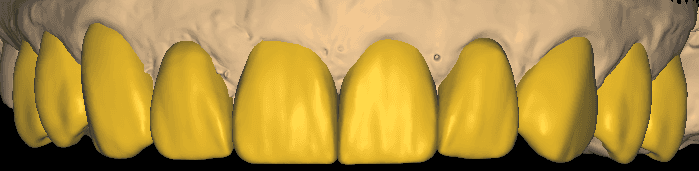 Digital Diagnostic Wax-Up