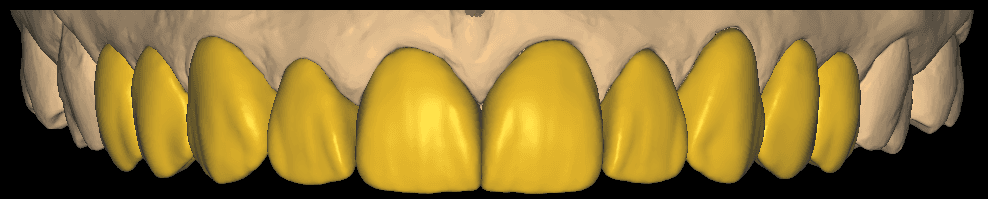 10-Unit Anterior Veneer CAD Design