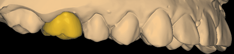 Single-Unit Posterior Crown CAD Design