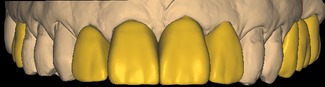 Anterior Single Crowns & Posterior 3-Unit Bridge CAD Design