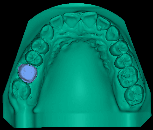 Digital Model with Full Palatal Base Design
