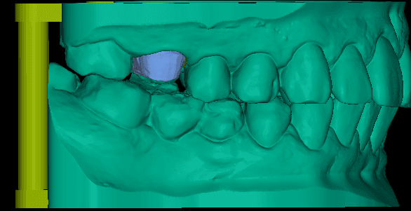 Digital Articulated Model & Occlusal Alignment Pin