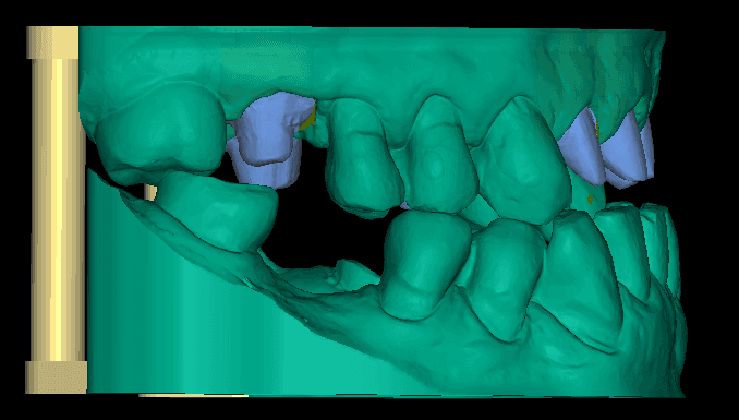 Digital Model with Removable Dies & Articulation Pins Design