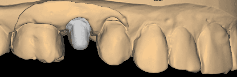 Single-Unit Premolar Crown CAD Design - before